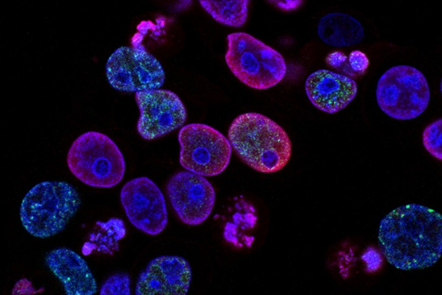 Cancer survival worsened early in pandemic, then improved