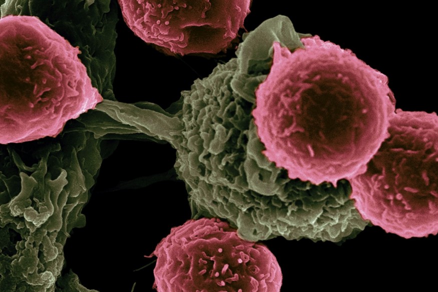 Cancer cases in Wales projected to rise 11% by 2035